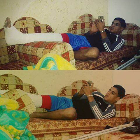قدم نجم خدمات خانيونس بالجبس